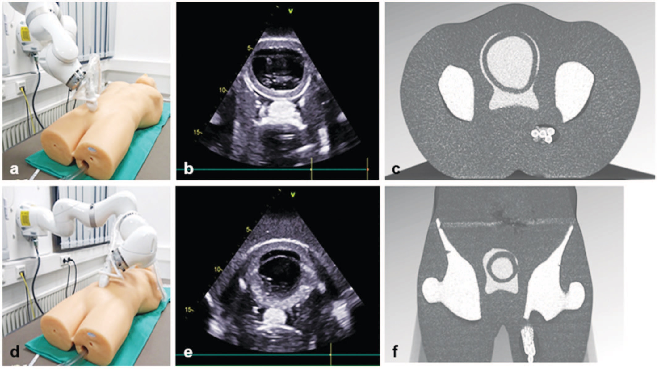 The use of an ultrasound robot for ultrasound-guided radiotherapy