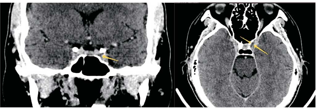 Тромбоз кавернозного синуса в аксиальной и коронарной проекции компьютерно-томографической ангиографии артерий головного мозга с внутривенным контрастированием