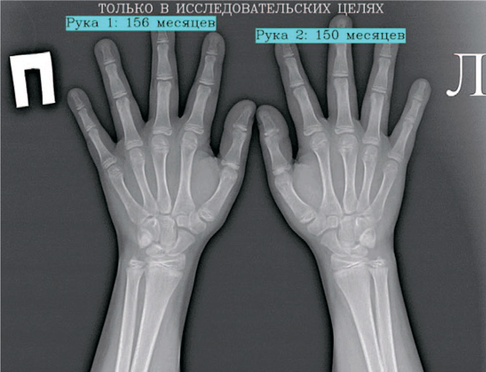 Пример аннотированного изображения с выводом костного возраста для исследования из ЕРИС ЕМИАС