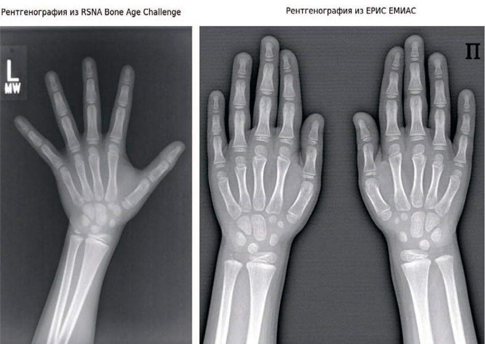 Методологиями проведения рентгенографии кисти в РФ и США